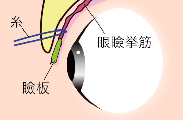 瞼板に触れず挙筋と皮膚を糸で繋ぐ